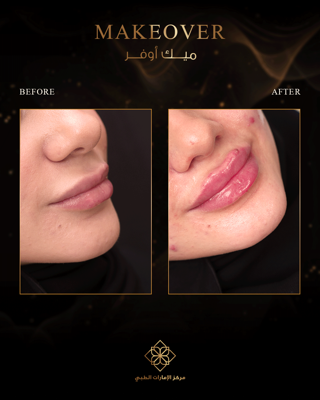 EMIRATES-MC-Before-AfterArtboard-11
