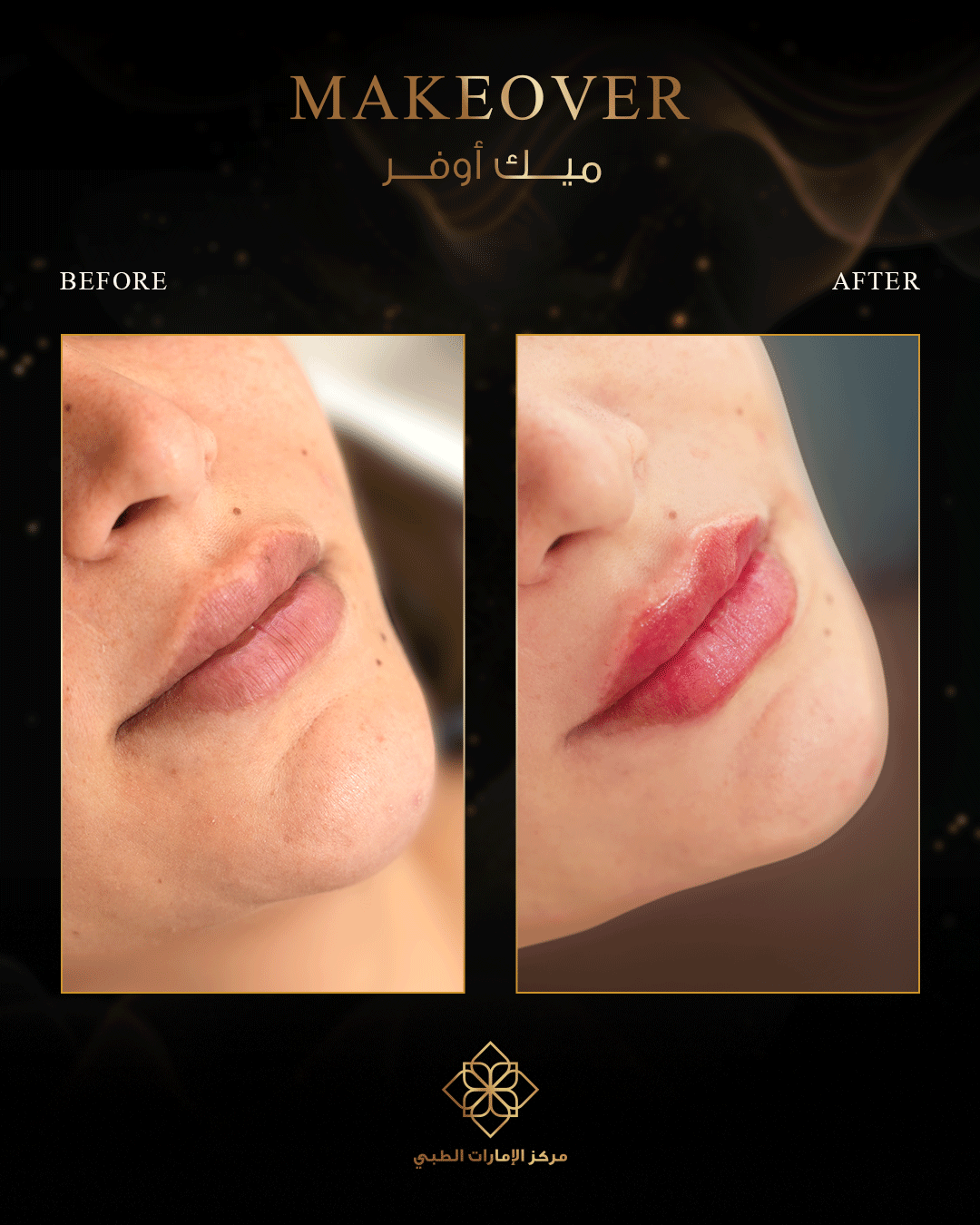 EMIRATES-MC-Before-AfterArtboard-6